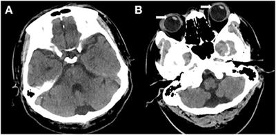 Case report: Spiller syndrome initially mimicking vestibular neuritis